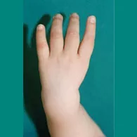 Handchirurgie, linke Hand mit fehlendem Daumen vor der Operation