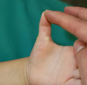 Handchirurgie, Tendovaginosis stenosans congenita, schnappender Daumen